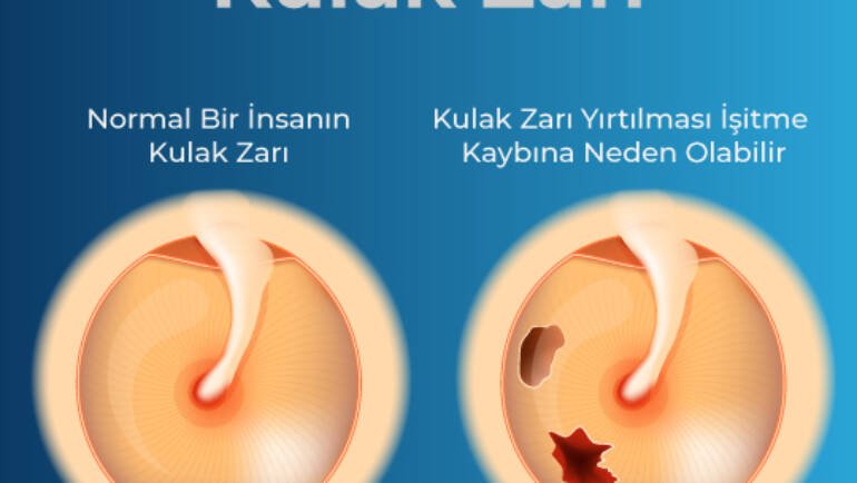 Kulak zarı deliği nasıl anlaşılır ve tedavi edilir?